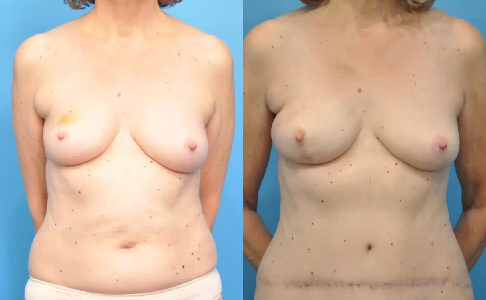 Before and After Image: Case #48 - front
