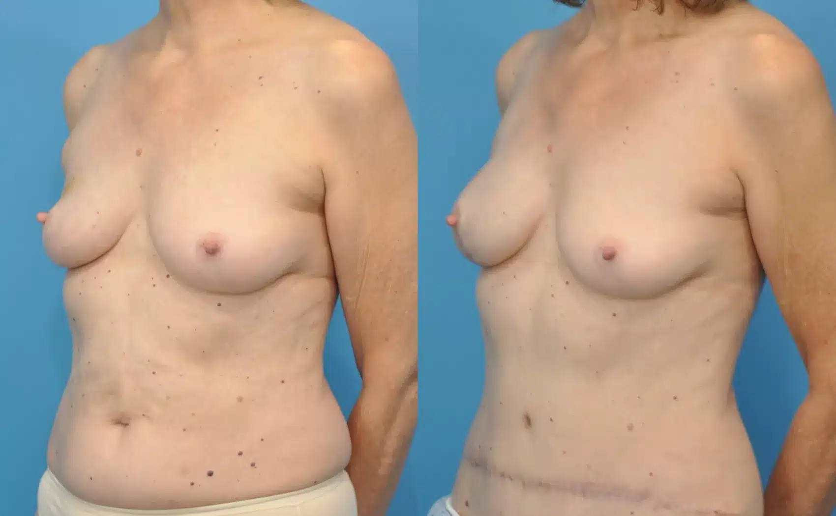 Before and After Image: Case #48 - left-front-oblique