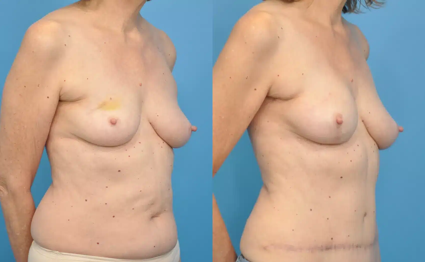 Before and After Image: Case #48 - right-front-oblique