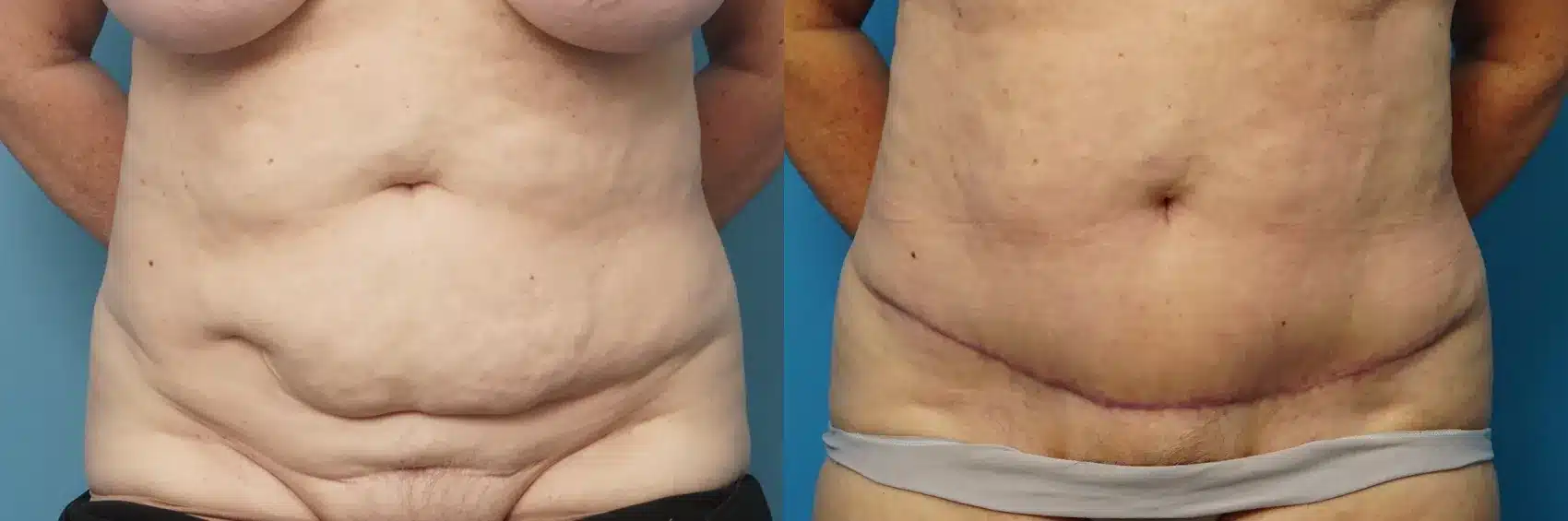 Before and After Image: Mini-Tummy Tuck/Panniculectomy - front
