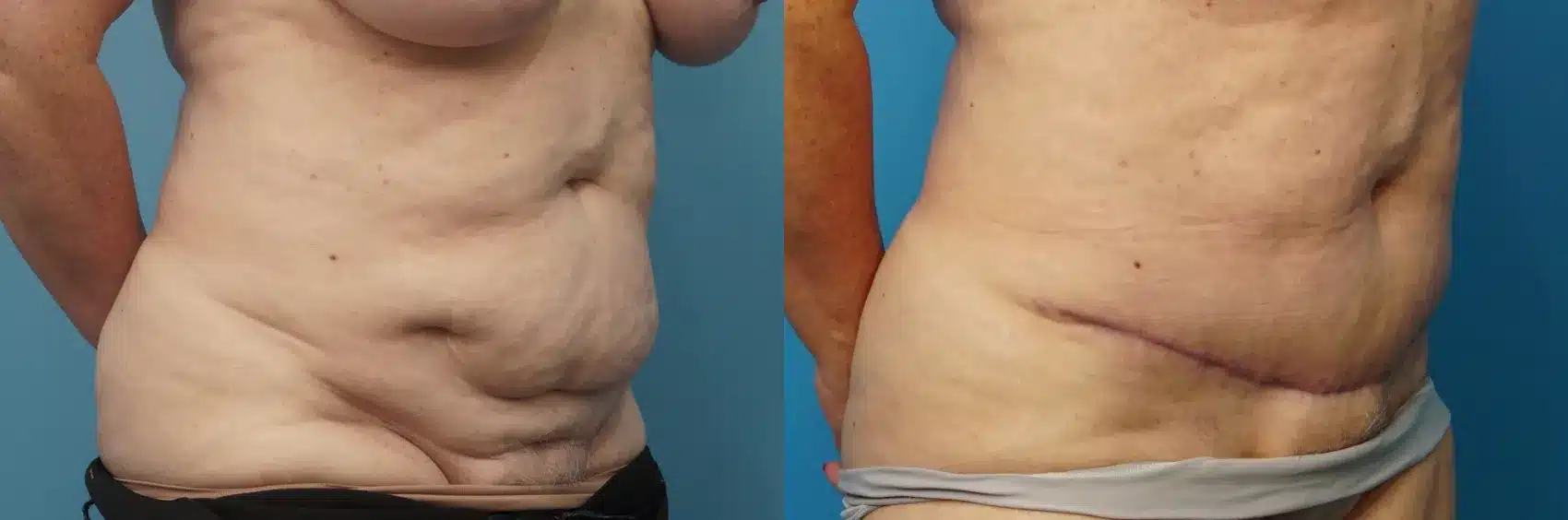 Before and After Image: Mini-Tummy Tuck/Panniculectomy - right-front-oblique