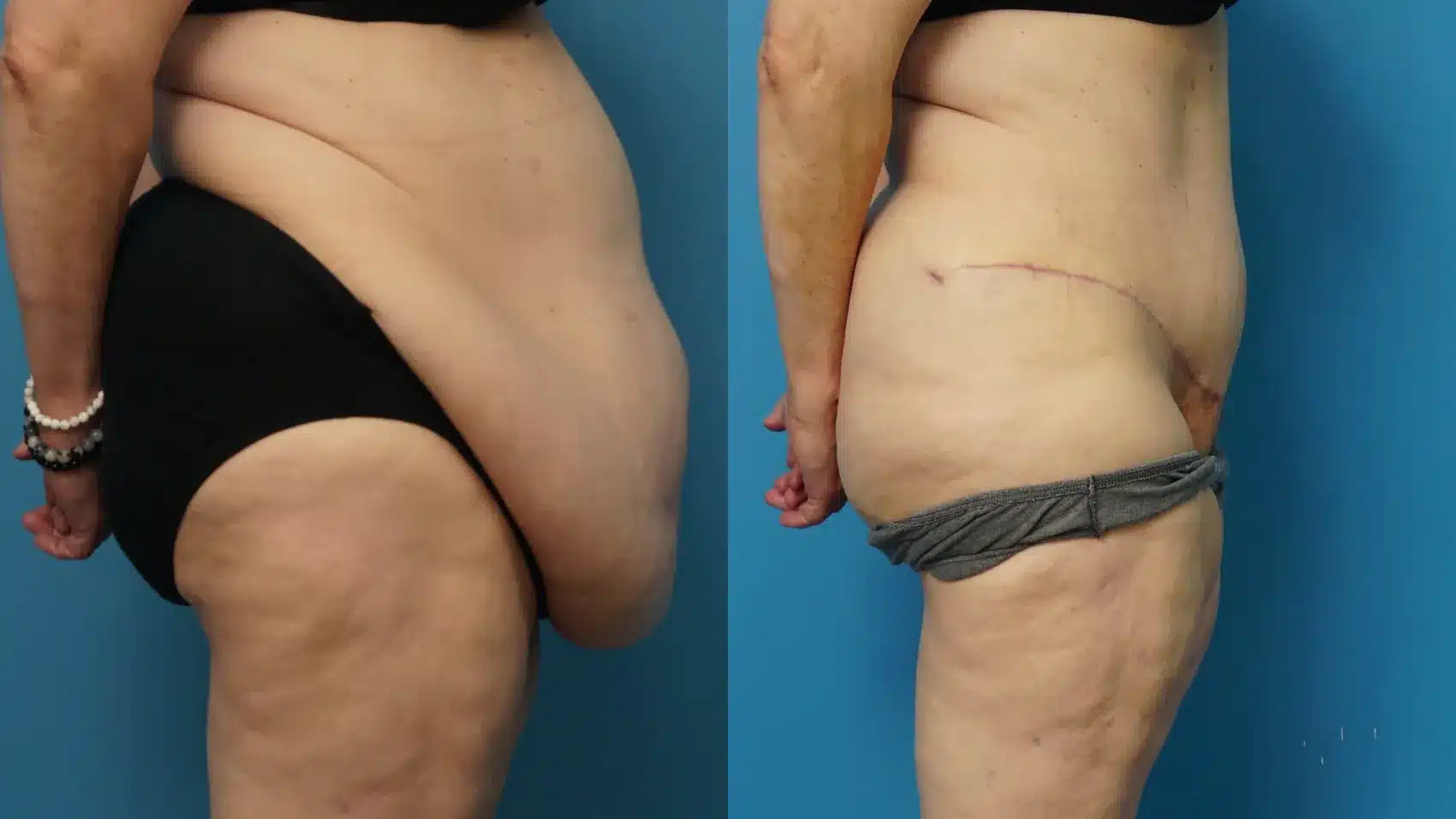 Before and After Image: Tummy tuck after massive weight loss - right-side