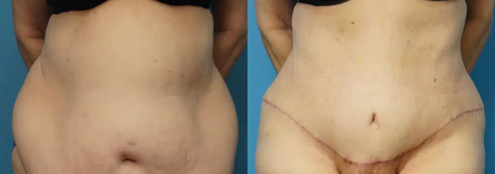 Before and After Image: Tummy tuck after massive weight loss - front