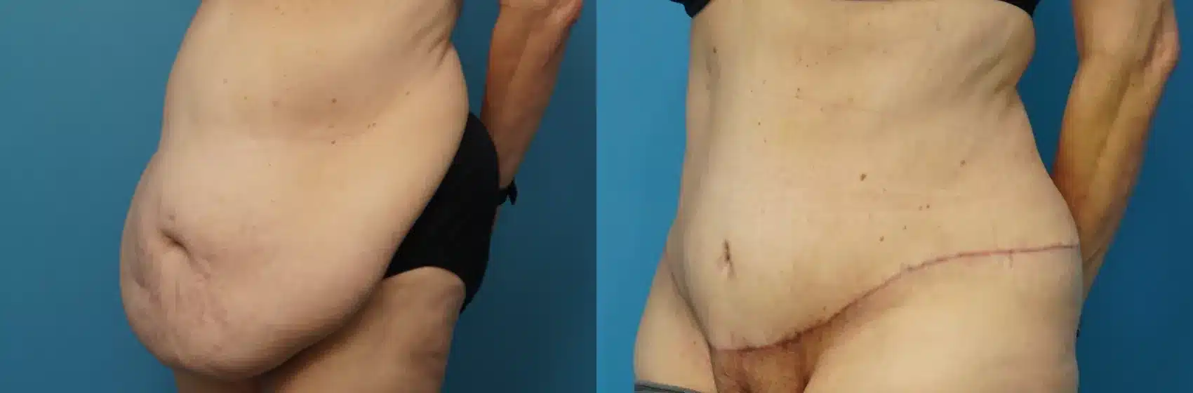 Before and After Image: Tummy tuck after massive weight loss - left-front-oblique