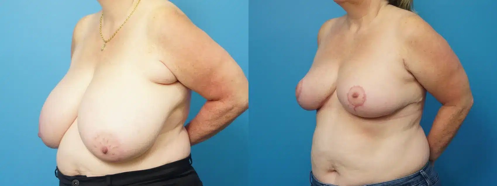 Before and After Image: Breast Reduction/Lift and Excision of Axillary Tissue - left-front-oblique