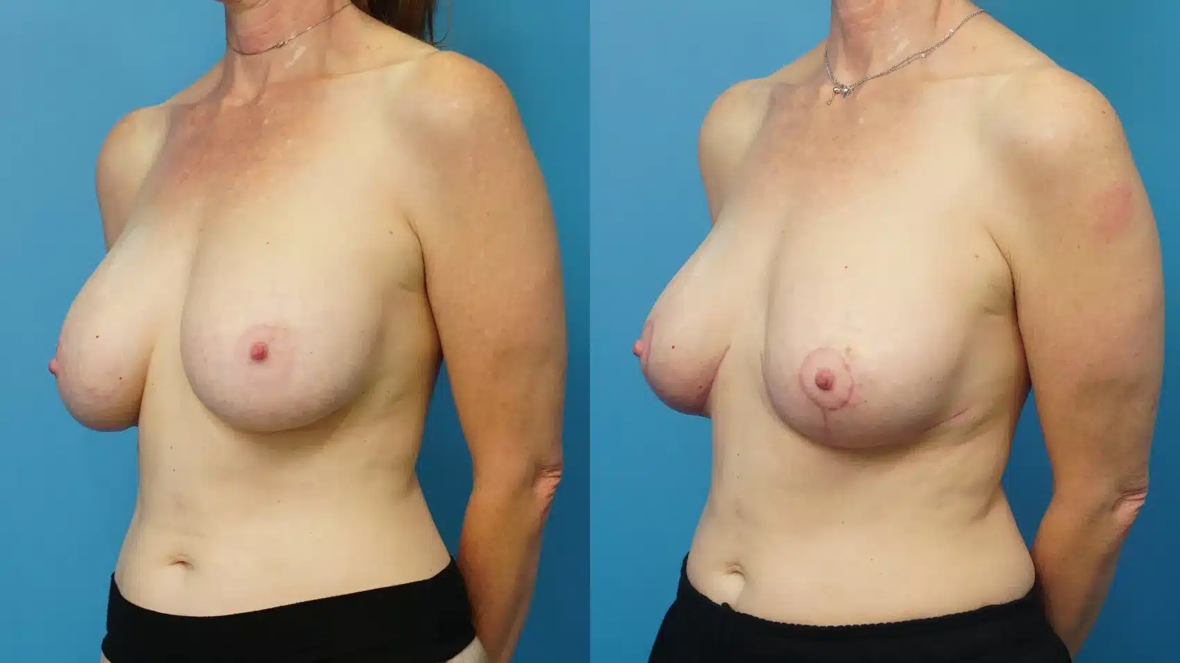 Before and After Image: Breast Implant Downsizing and Lift - left-front-oblique