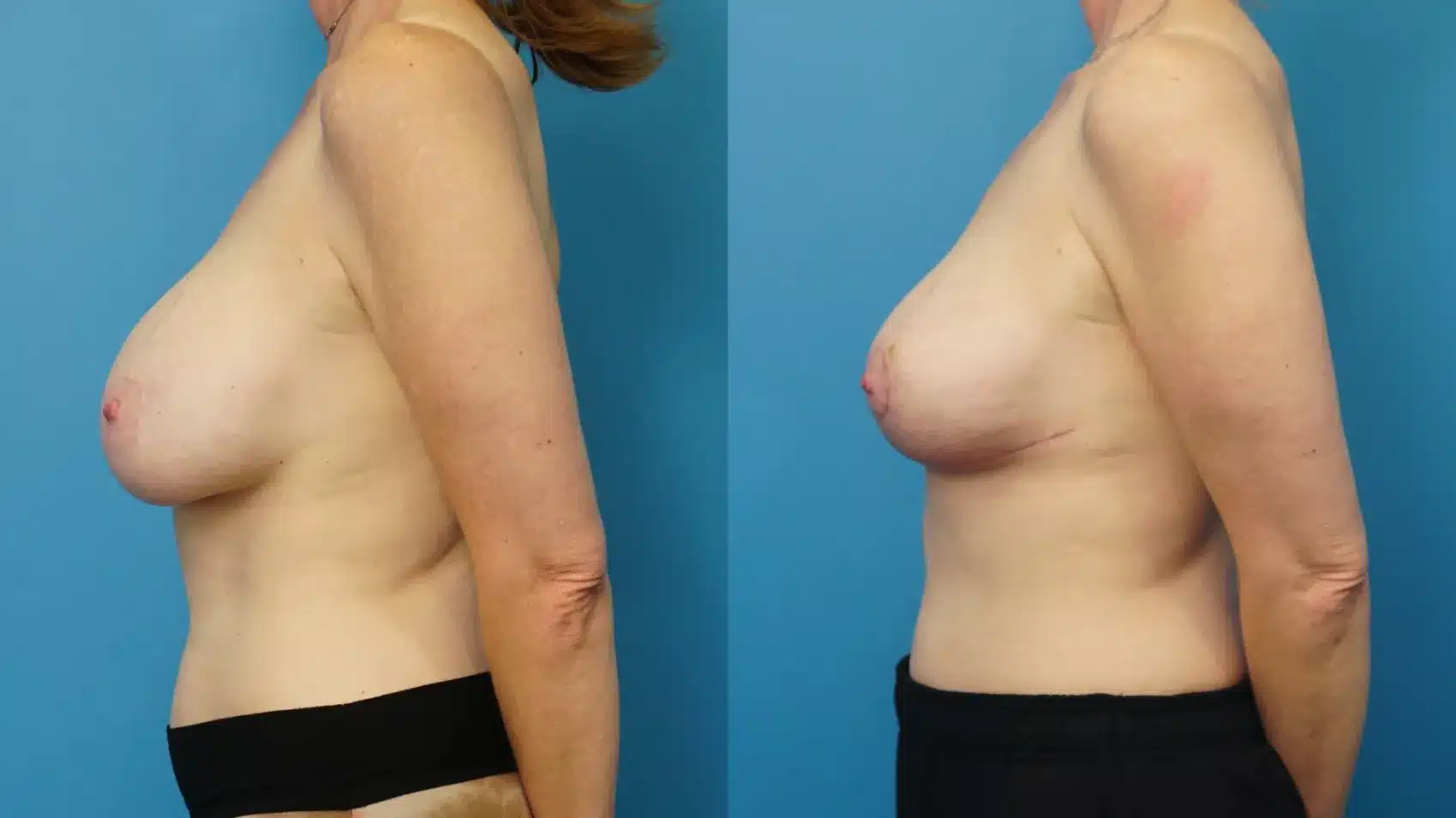 Before and After Image: Breast Implant Downsizing and Lift - left-side