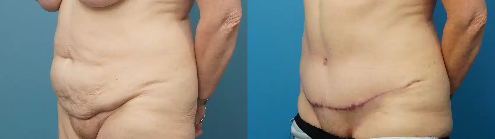 Before and After Image: Abdominoplasty - left-front-oblique