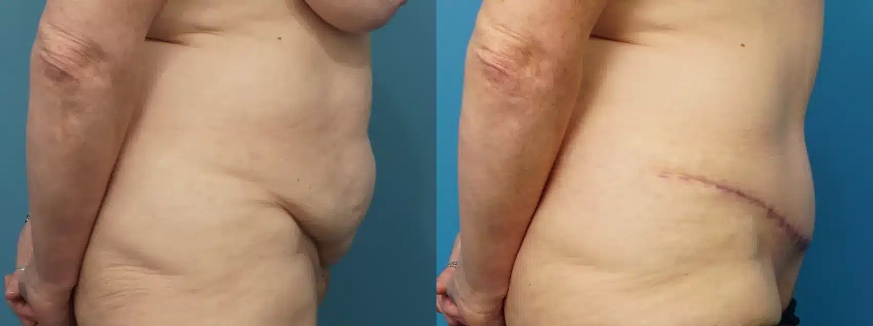 Before and After Image: Abdominoplasty - right-side