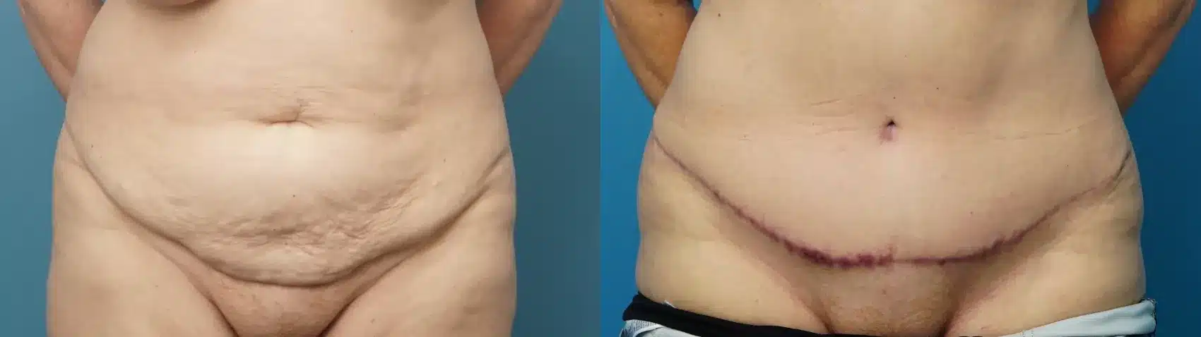 Before and After Image: Abdominoplasty - front
