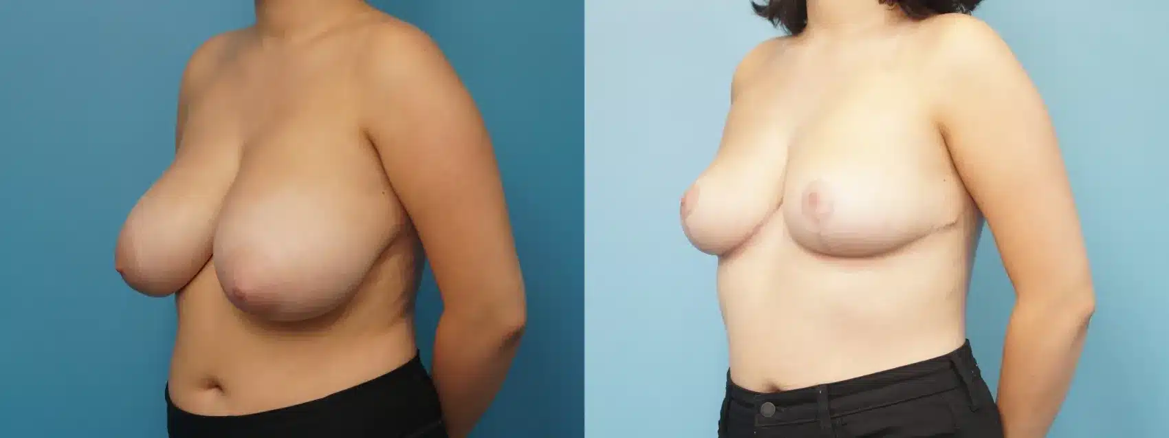 Before and After Image: Breast Reduction and lift - left-front-oblique