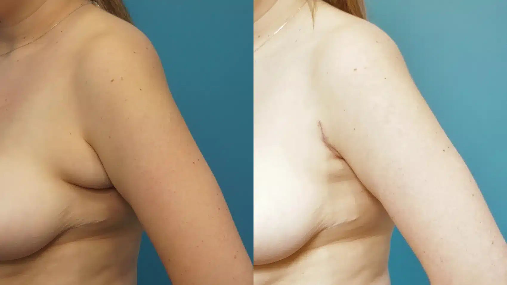 Before and After Image: Axillary Breast Tissue Excision