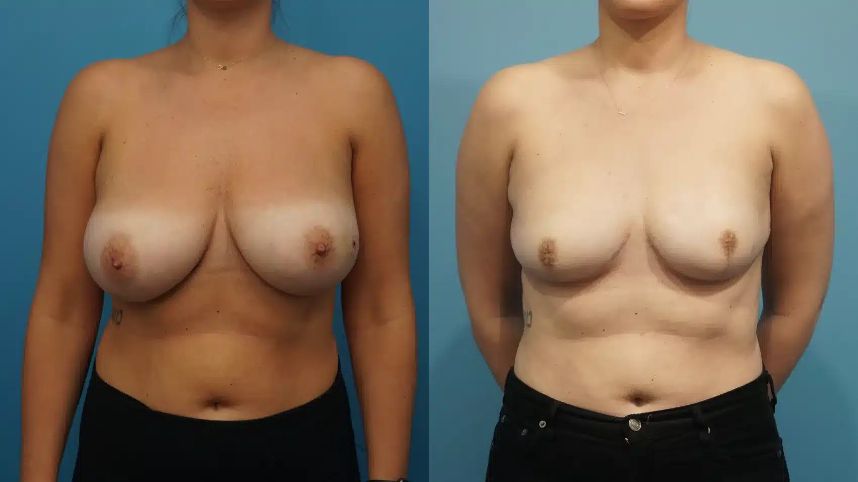 Before and After Image: Areola-Sparing Mastectomy Reconstruction with Implants - front