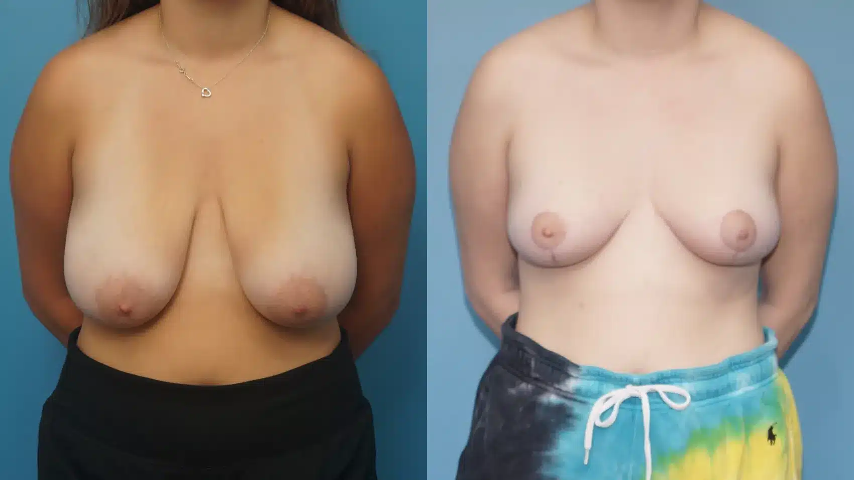 Before and After Image: Breast Reduction and lift - front