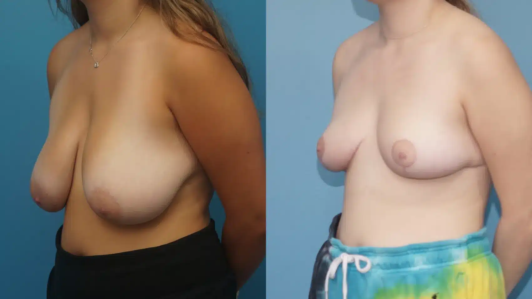 Before and After Image: Breast Reduction and lift - left-front-oblique