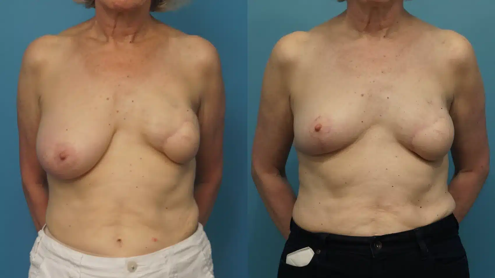 Before and After Image: Revision of Breast Reconstruction - front
