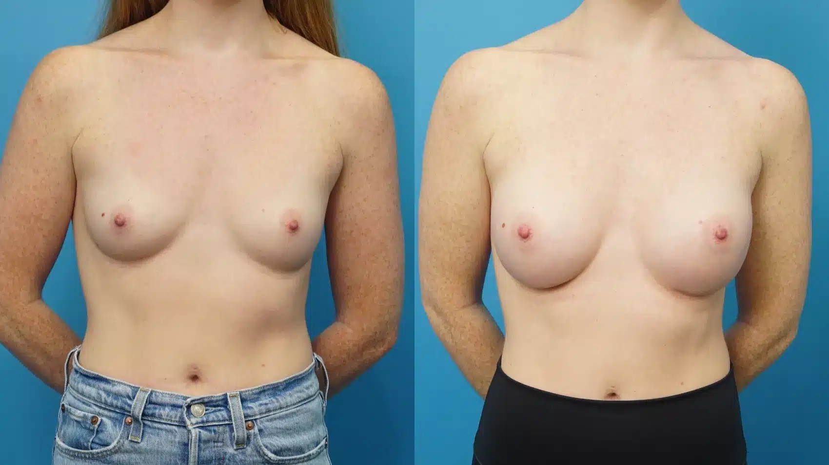 Before and After Image: Breast Augmentation 265 ml Silicone - front