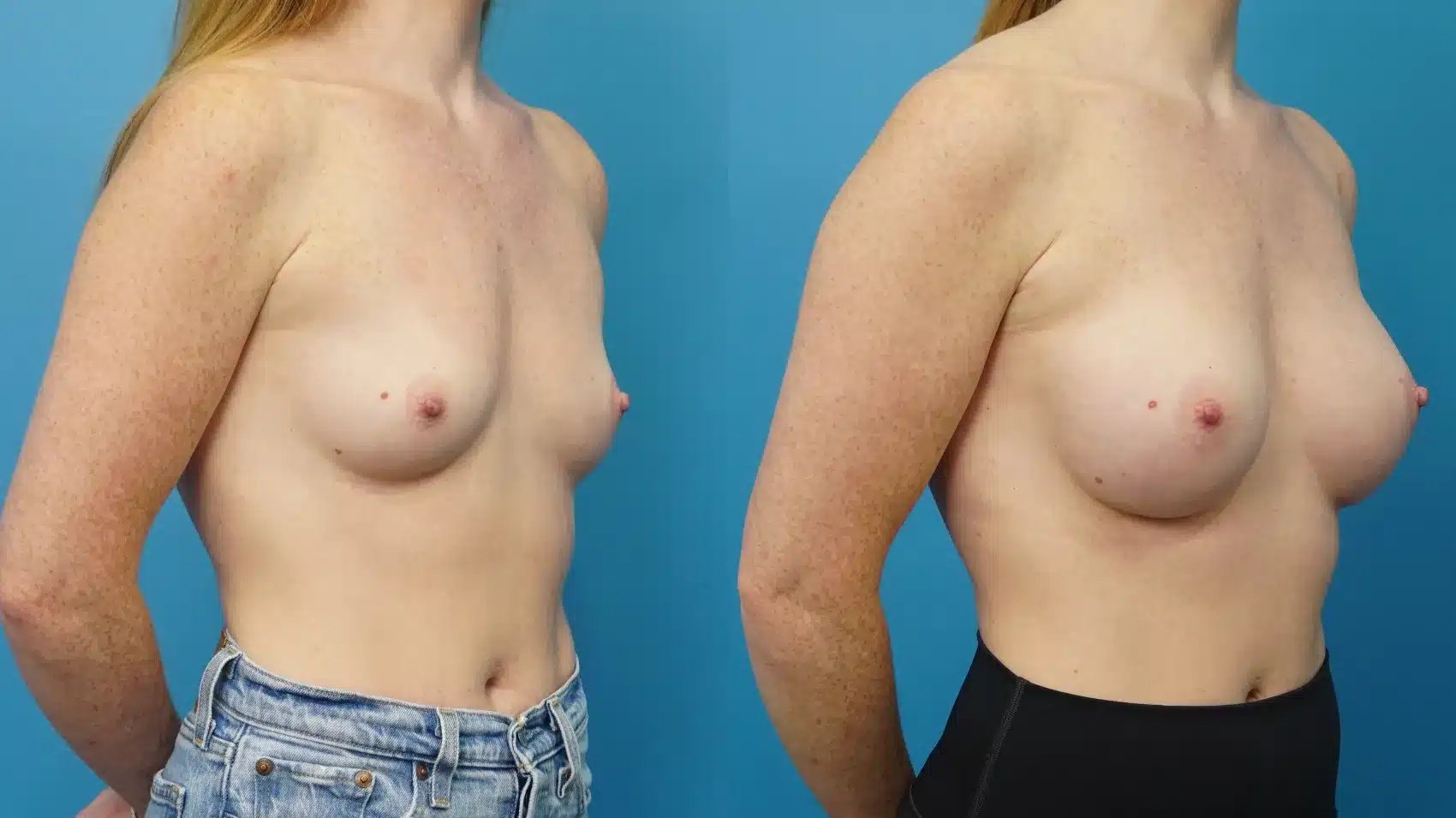 Before and After Image: Breast Augmentation 265 ml Silicone - right-front-oblique