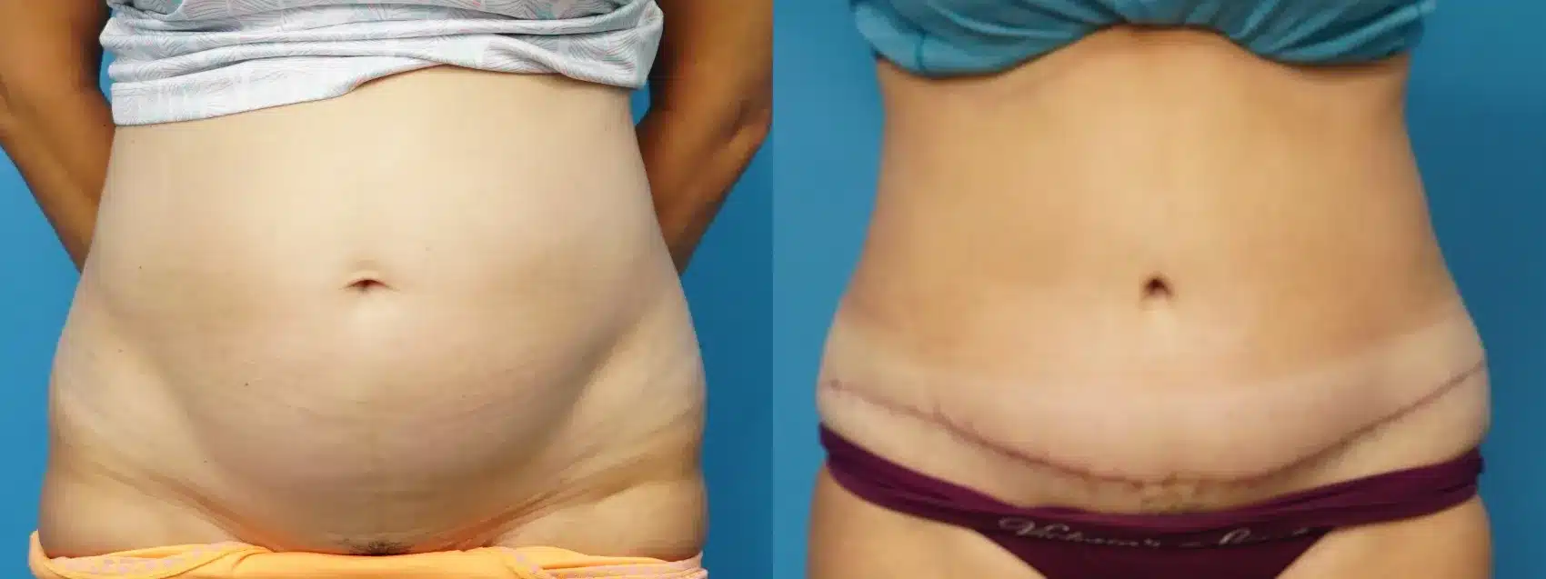 Before and After Image: Case #499 - front