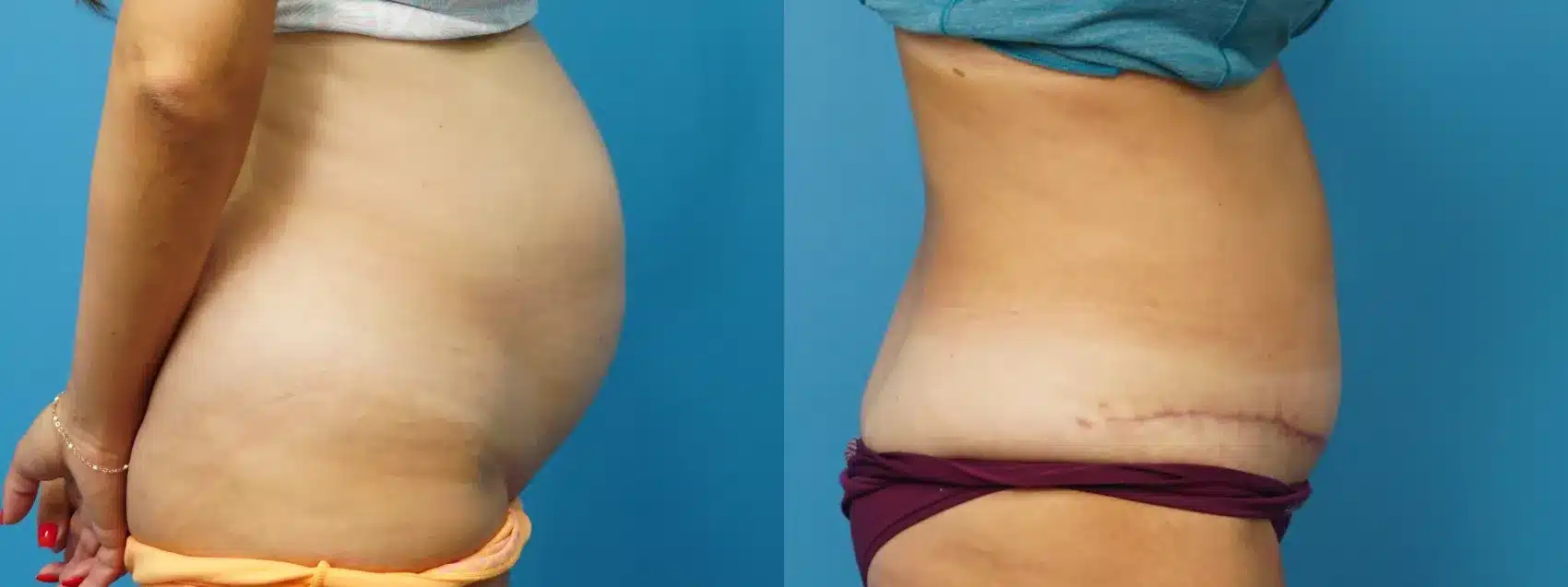 Before and After Image: Case #499 - right-side