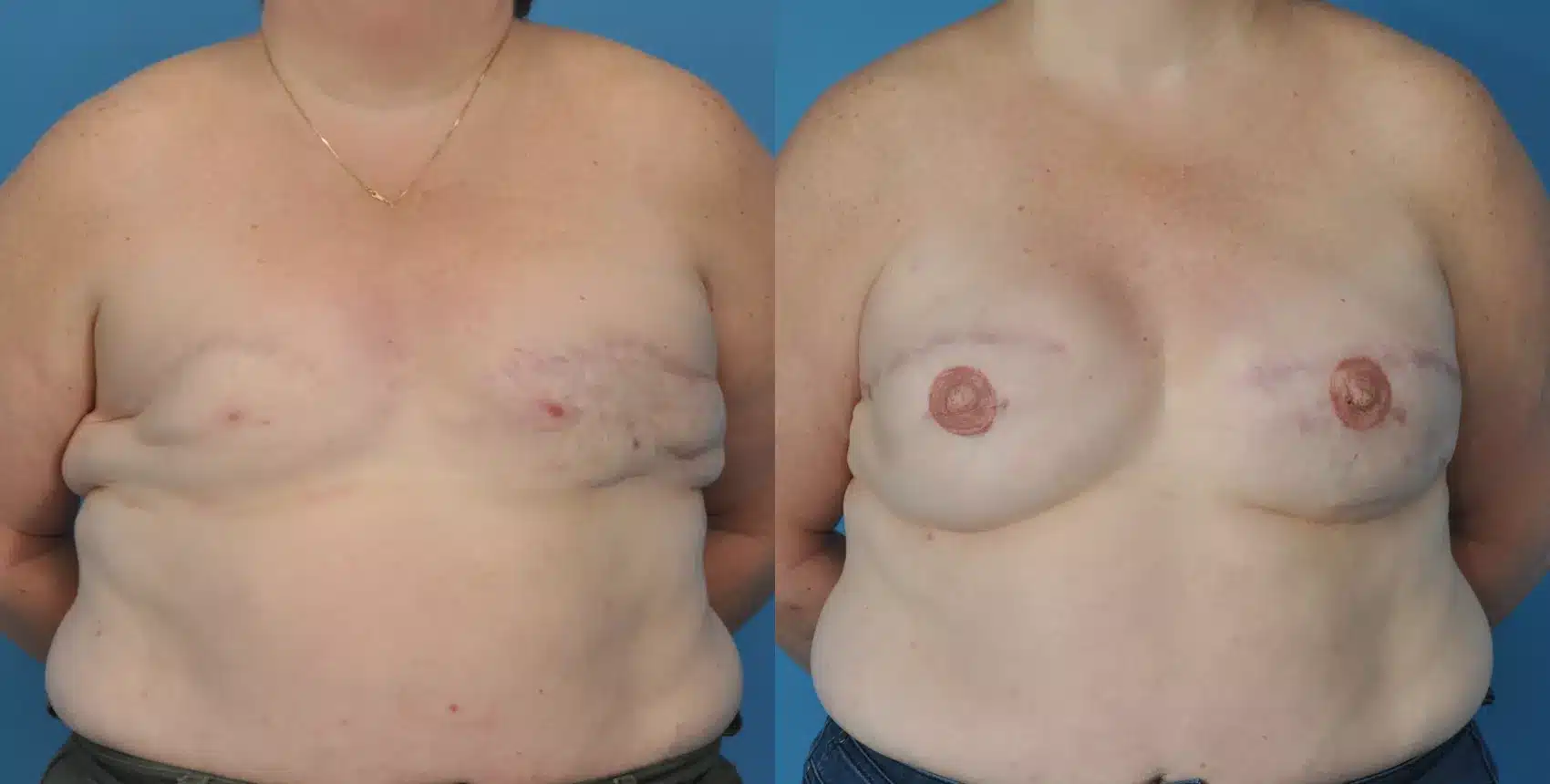 Before and After Image: Case #50 - front
