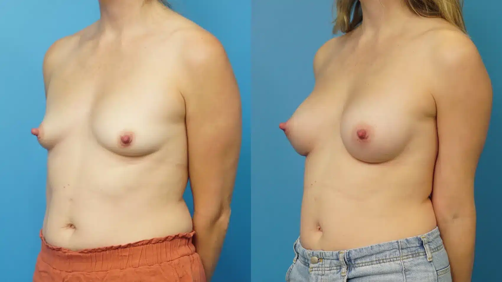 Before and After Image: Breast Augmentation 255 ml Silicone Implants - left-front-oblique