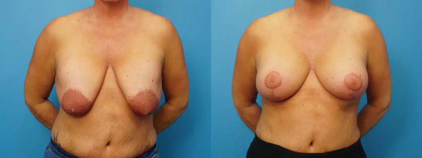 Before and After Image: Revision Breast Augmentation (390 ml Saline) with Lift - front