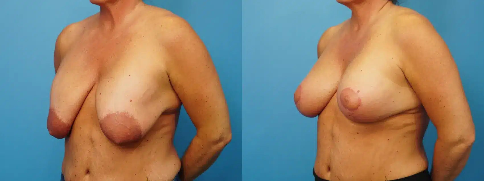 Before and After Image: Revision Breast Augmentation (390 ml Saline) with Lift - left-front-oblique
