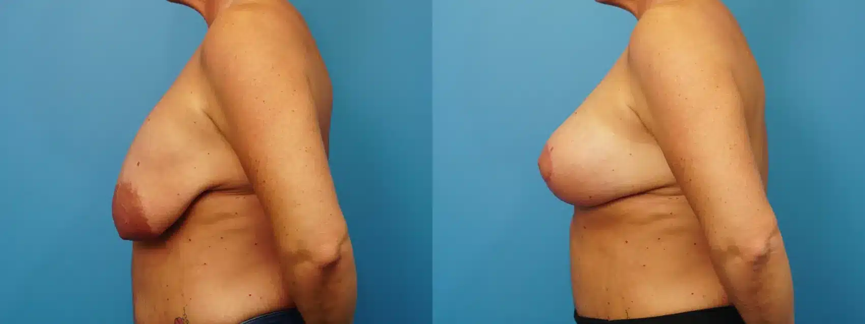 Before and After Image: Revision Breast Augmentation (390 ml Saline) with Lift - left-side