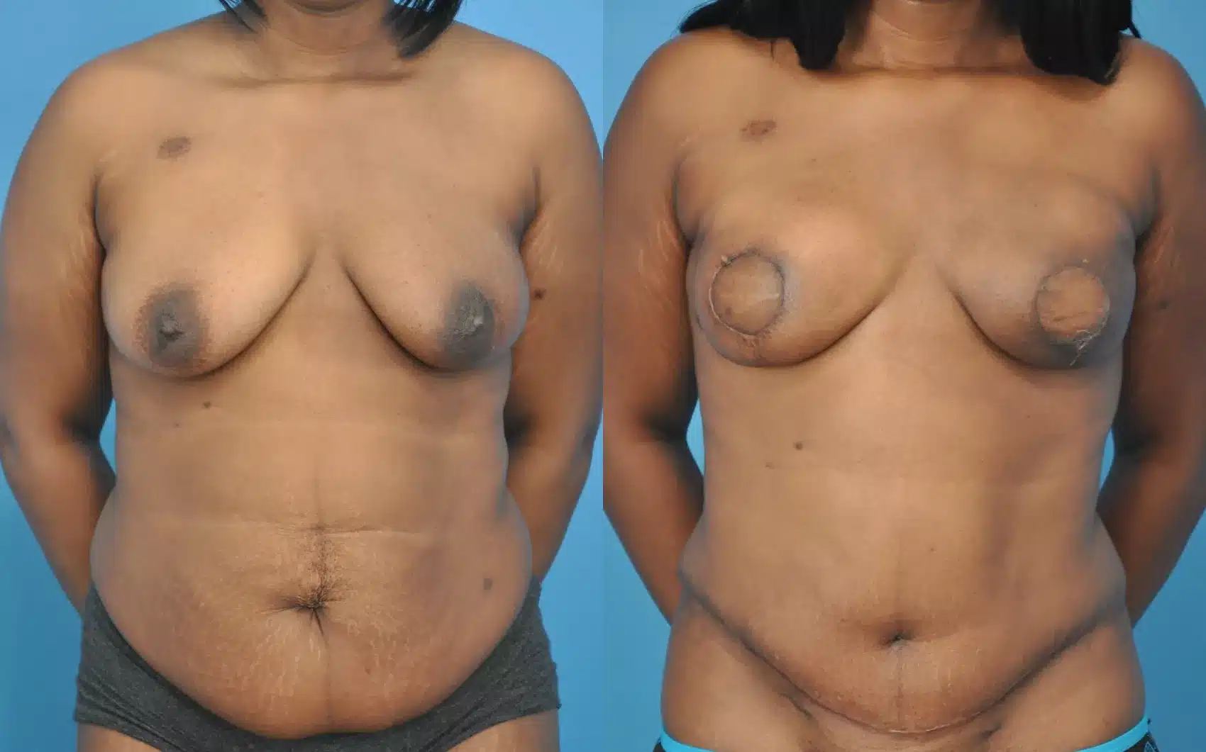 Before and After Image: Case #52 - front