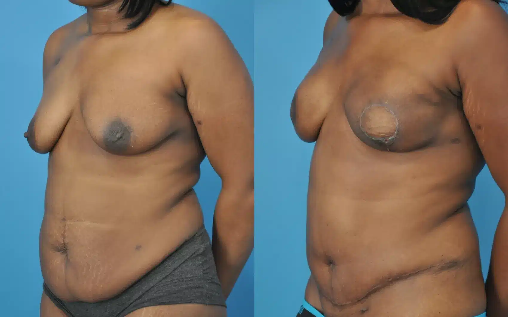 Before and After Image: Case #52 - left-front-oblique