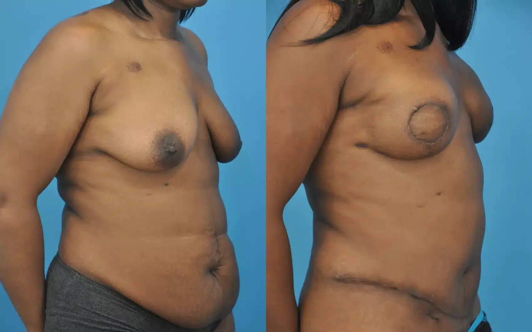 Before and After Image: Case #52 - right-front-oblique