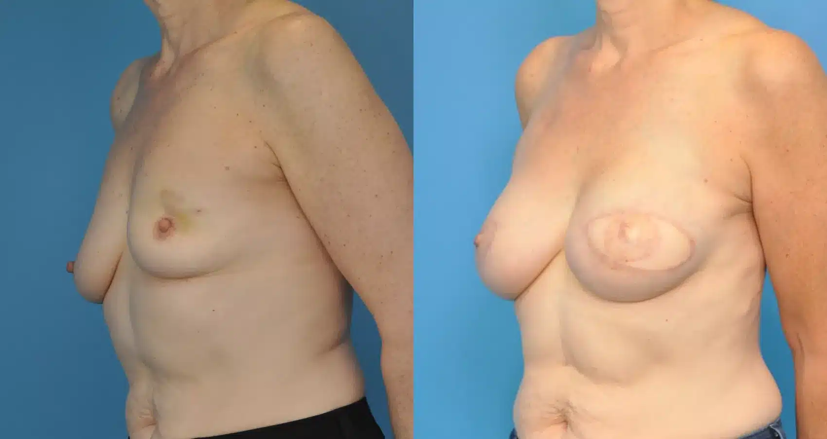 Before and After Image: Case #53 - left-front-oblique