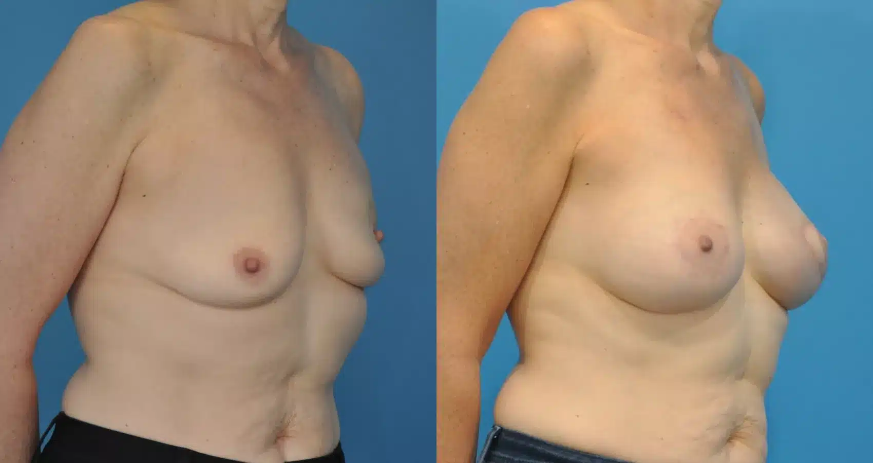 Before and After Image: Case #53 - right-front-oblique