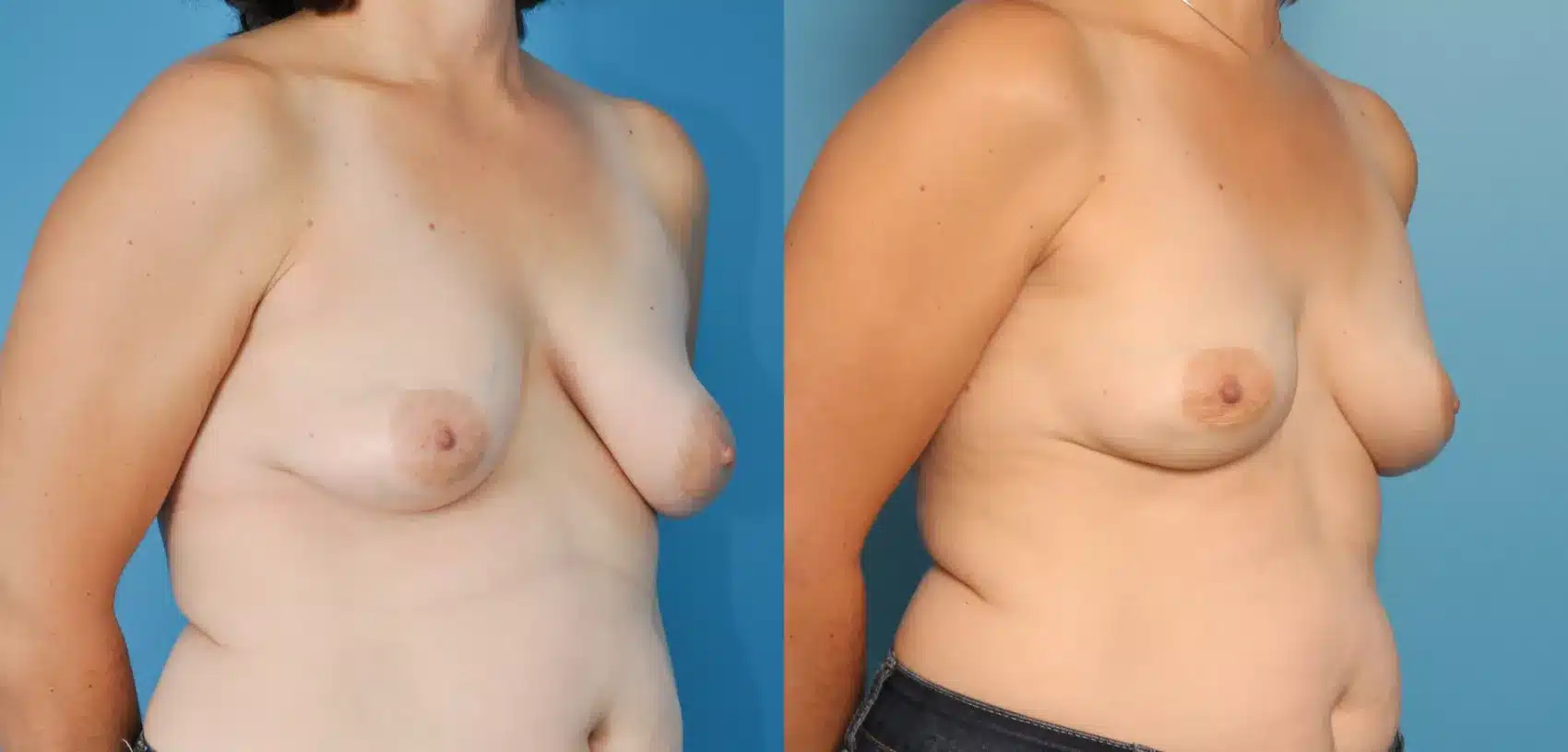 Before and After Image: Case #57 - right-front-oblique