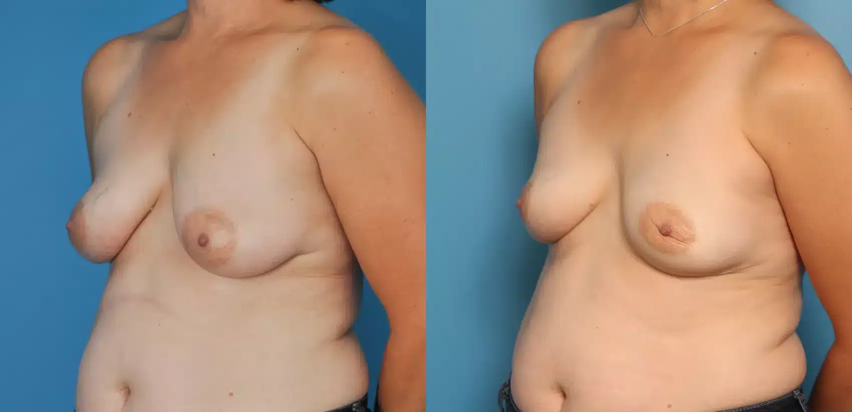 Before and After Image: Case #57 - left-front-oblique