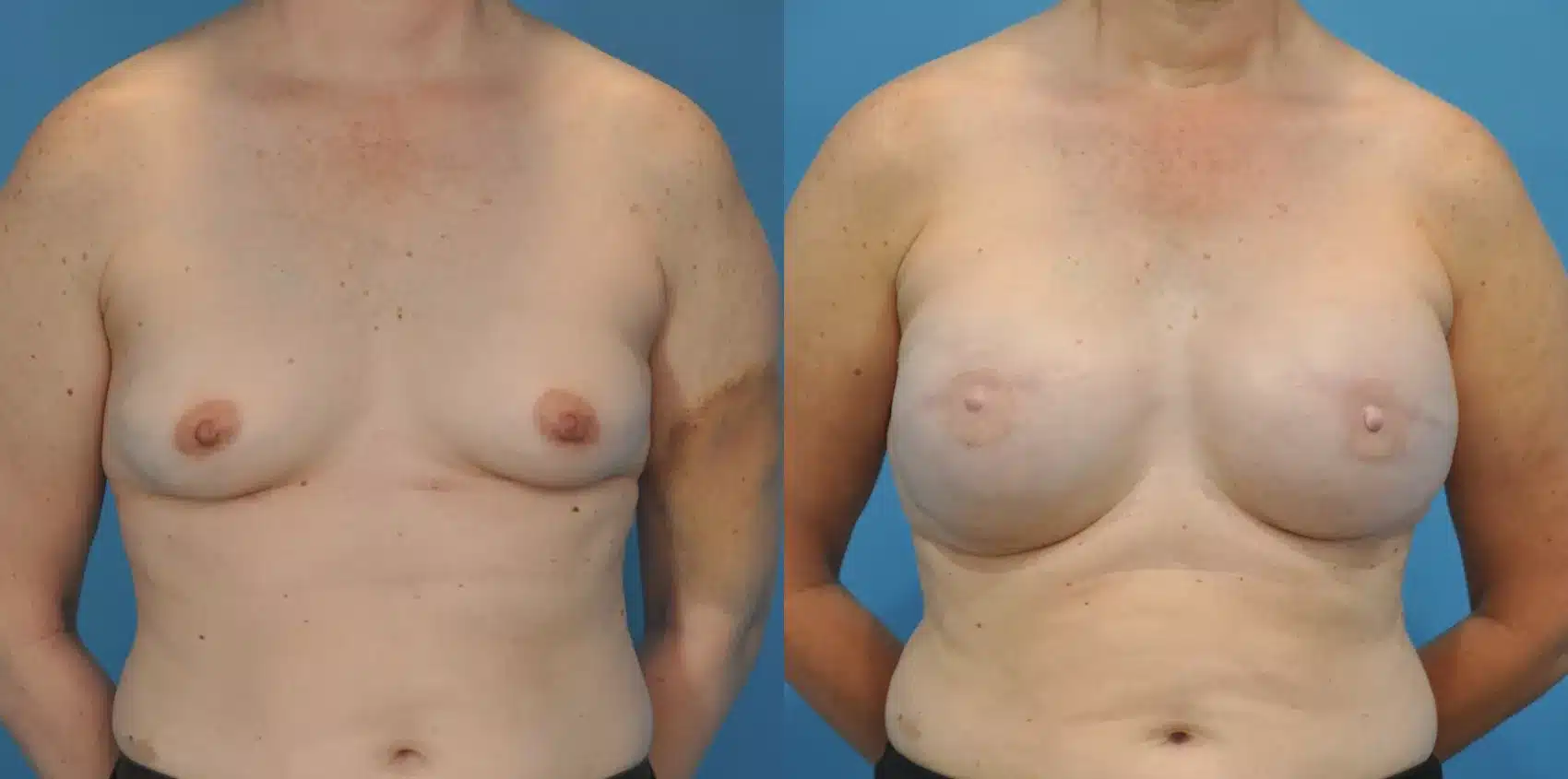 Before and After Image: Case #58 - front