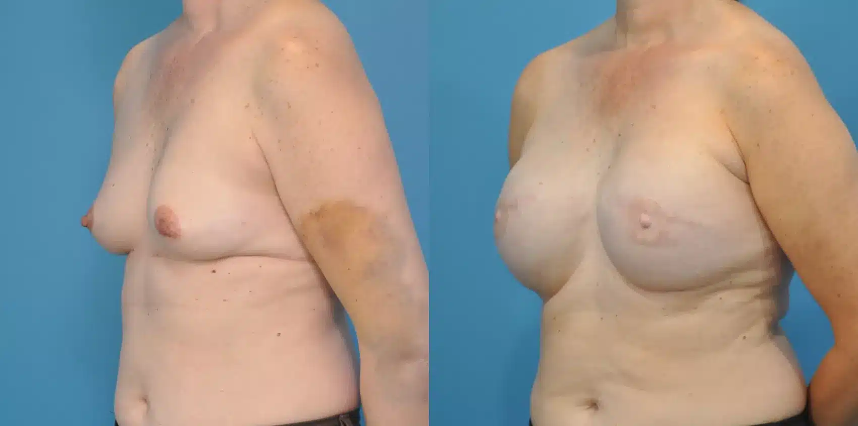 Before and After Image: Case #58 - left-front-oblique