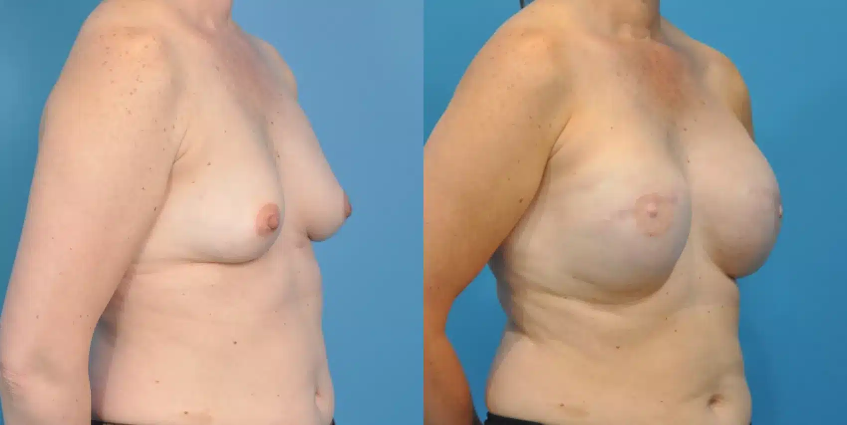 Before and After Image: Case #58 - right-front-oblique
