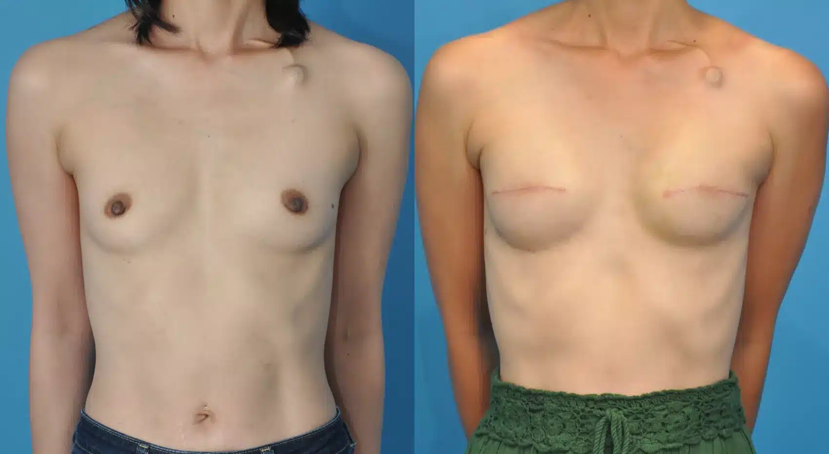 Before and After Image: Case #60 - front