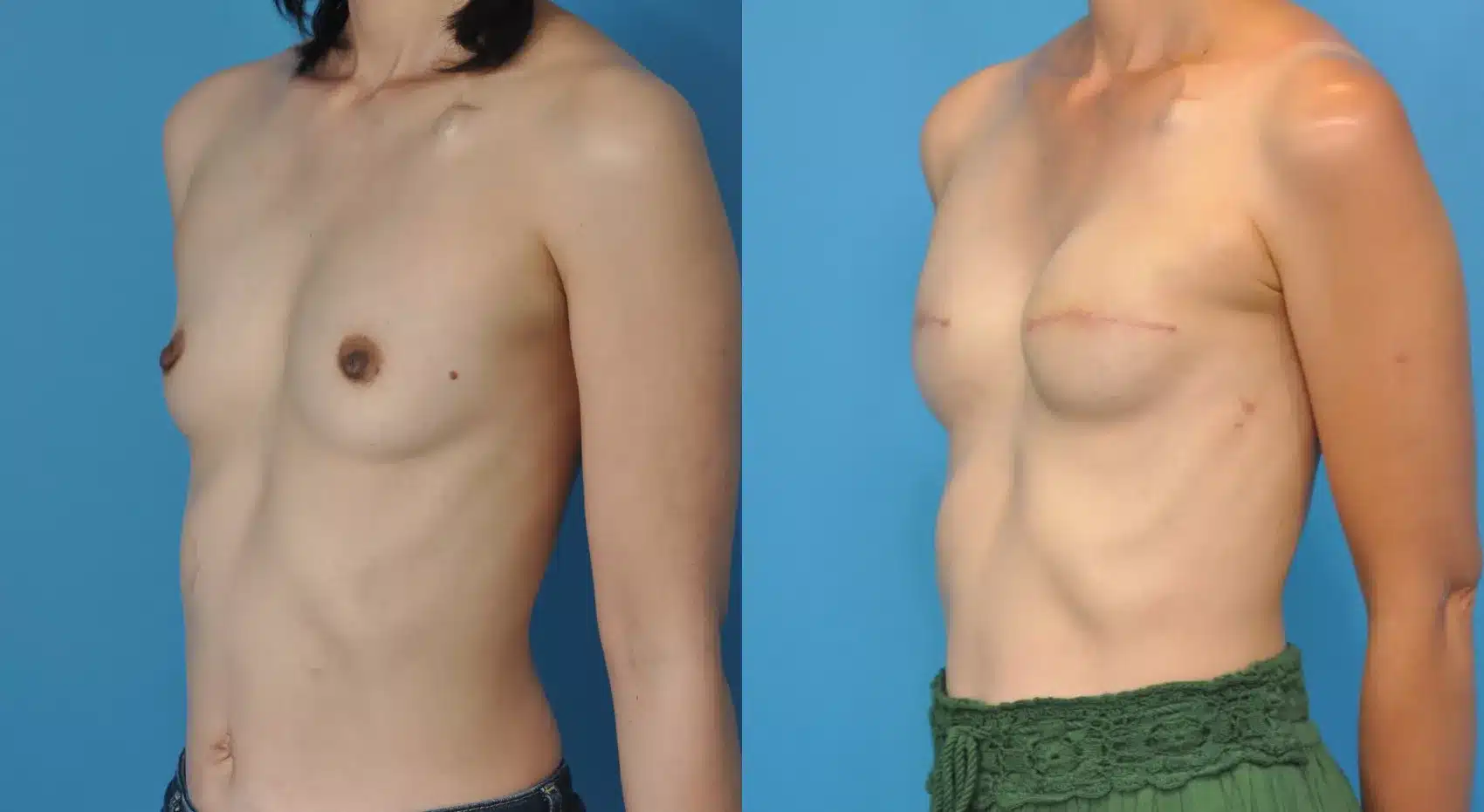 Before and After Image: Case #60 - left-front-oblique