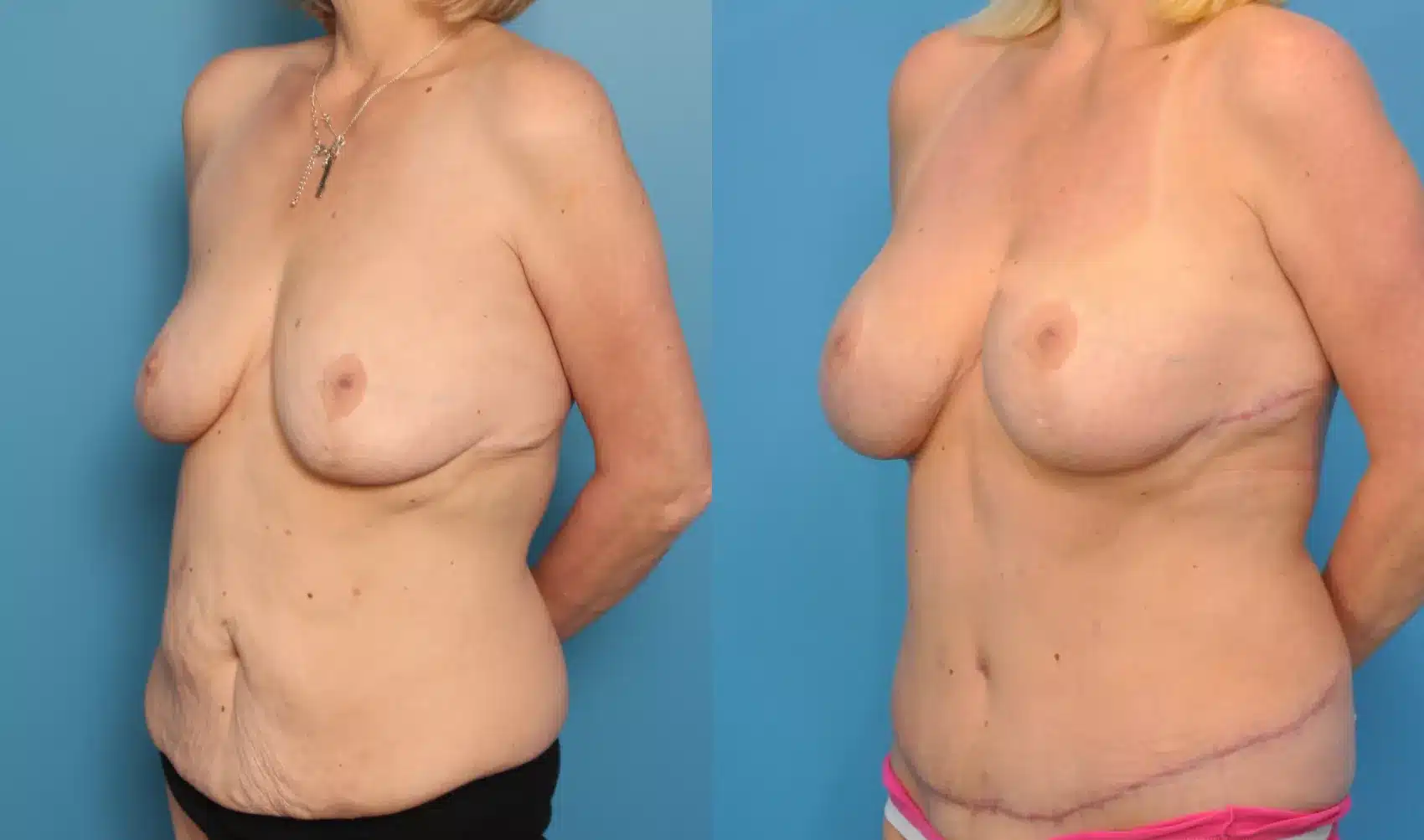 Before and After Image: Case #61 - left-front-oblique