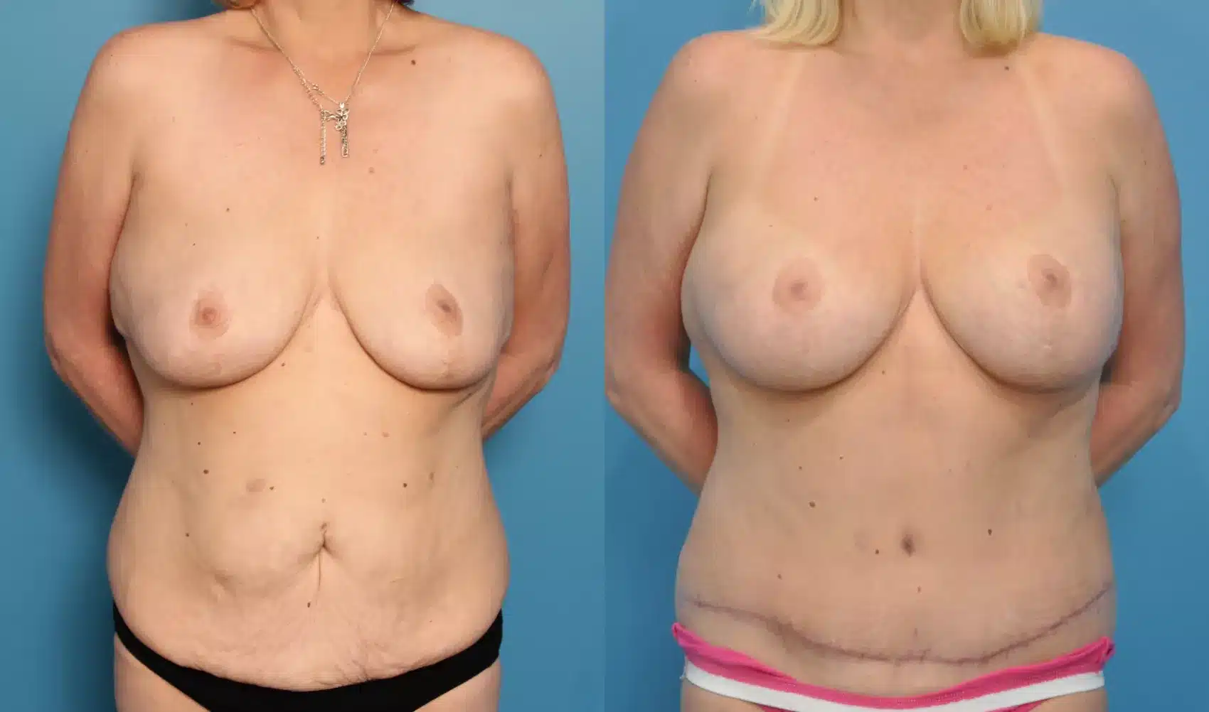 Before and After Image: Case #61 - front