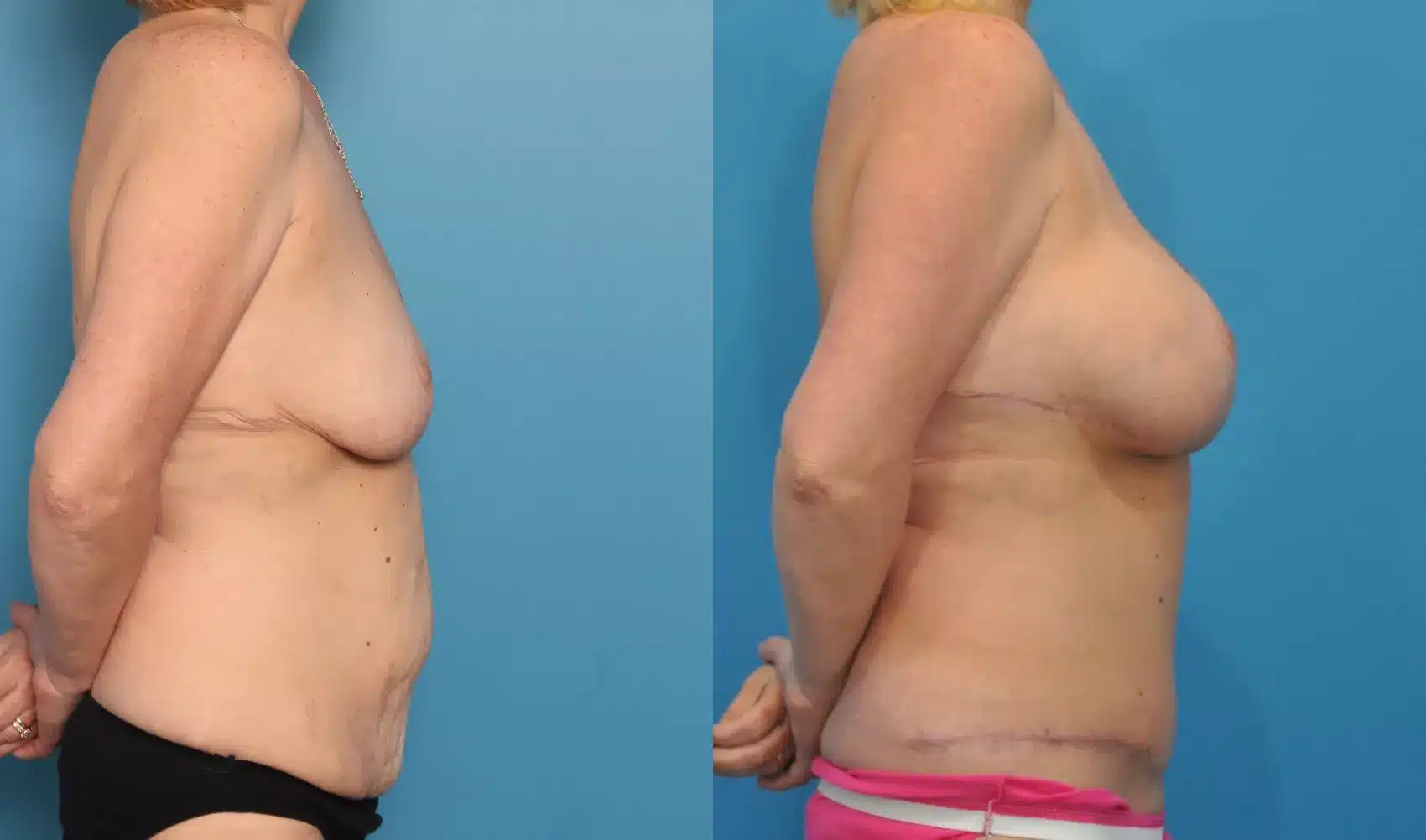Before and After Image: Case #61 - right-side