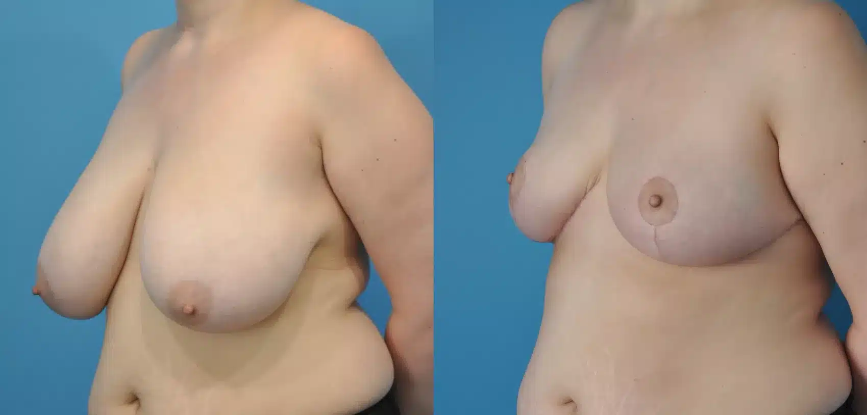 Before and After Image: Case #62 - left-front-oblique