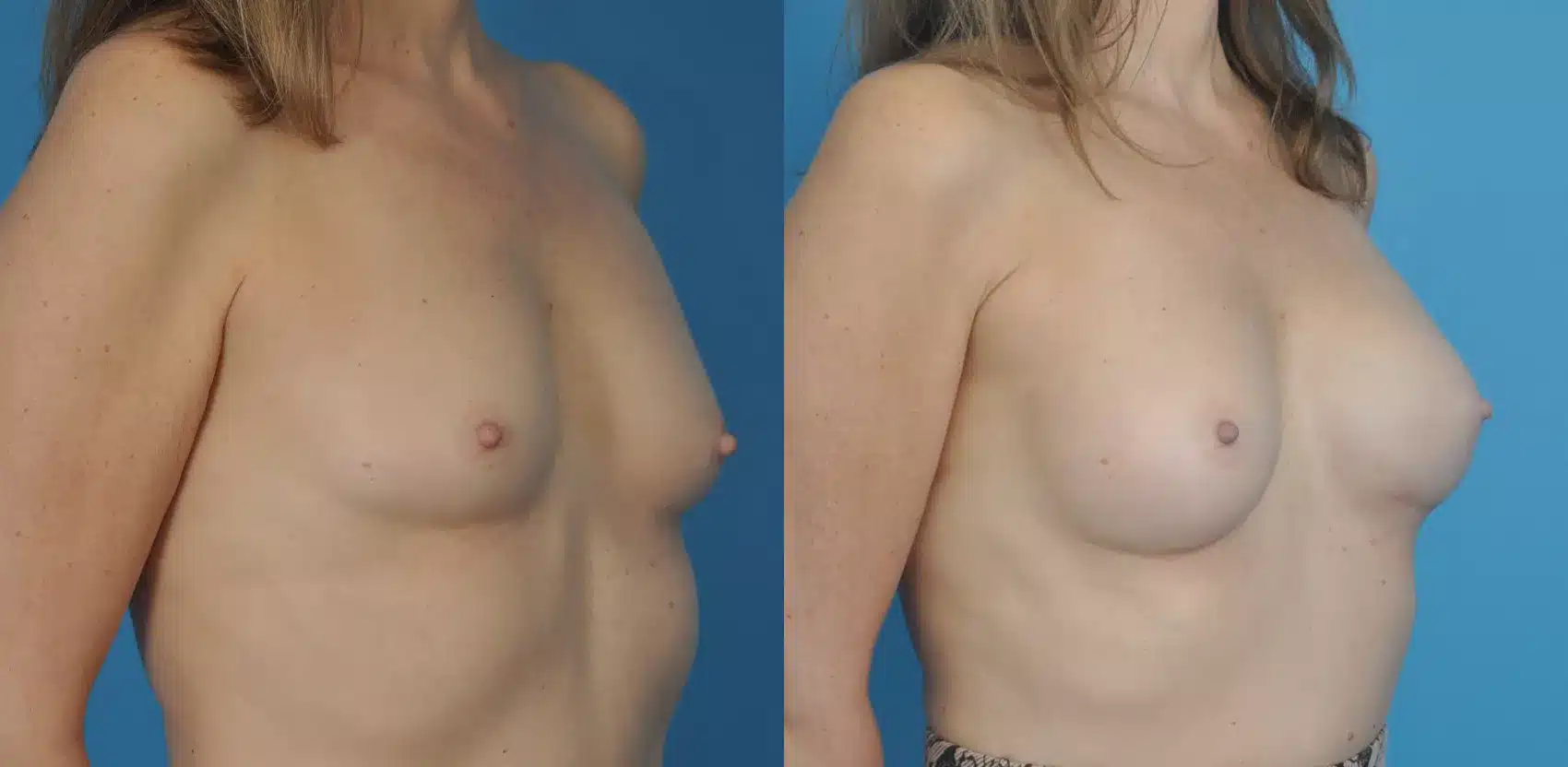 Before and After Image: Case #64 - right-front-oblique