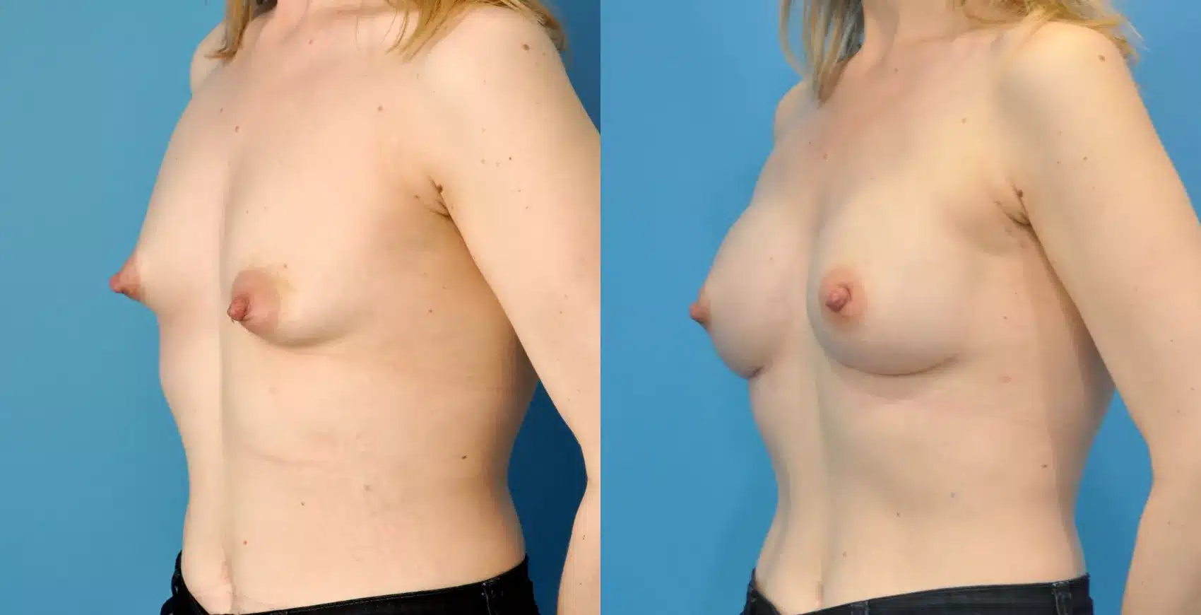 Before and After Image: Case #67 - left-front-oblique