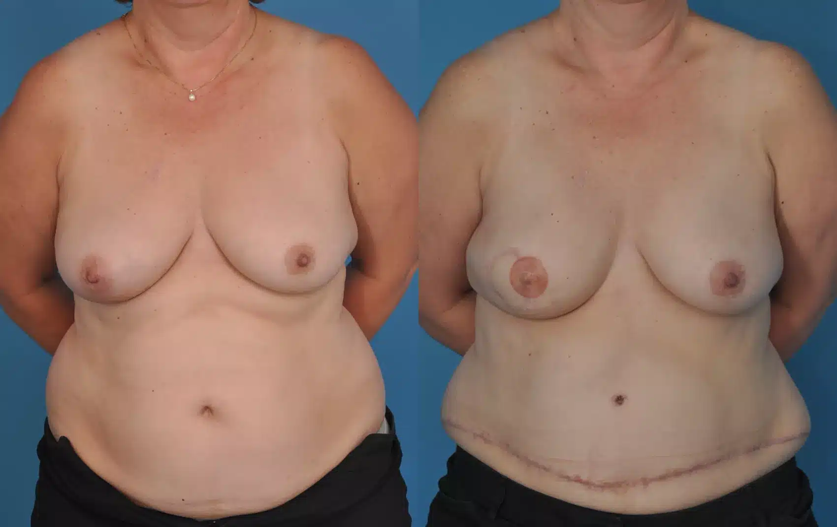 Before and After Image: Case #69 - front