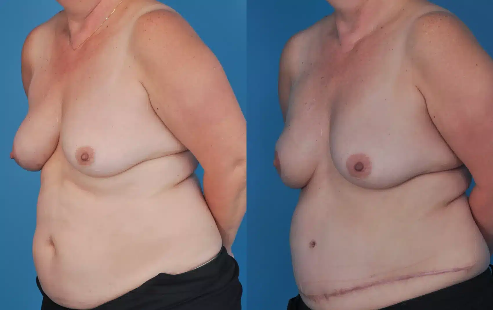 Before and After Image: Case #69 - left-front-oblique