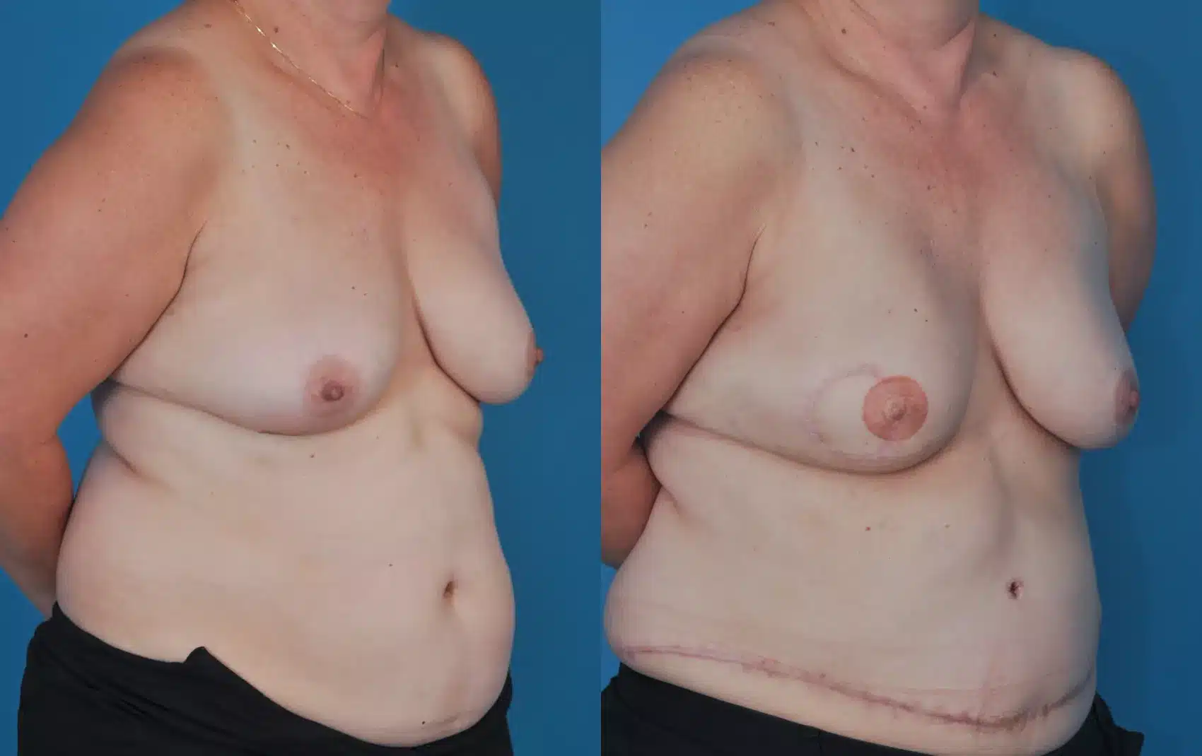 Before and After Image: Case #69 - right-front-oblique